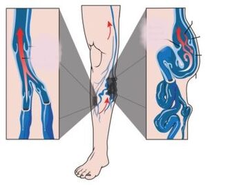 Põhjused, sümptomid