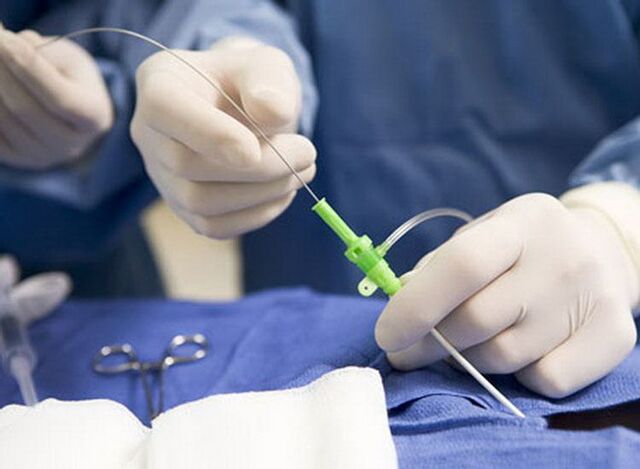 Raadiosageduslik ablatsioon